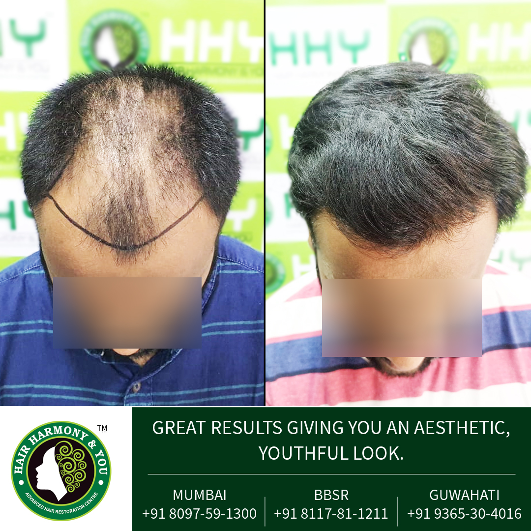 hair transplant result