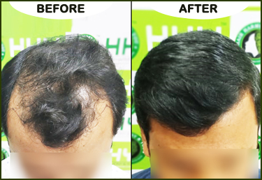 hair transplant cost in Bhubaneswar Archives  Dr Alok Sahoo