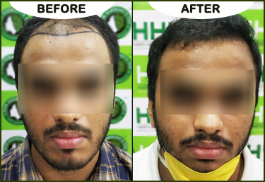 Hair Transplant in Guwahati  Clinics Cost  Treatment  Keratin Strings