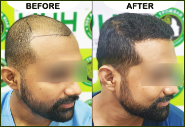 Beard Transplant  Beard Transplant Procedure Results  Cost in India