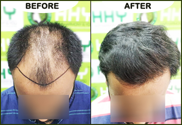 HHY Hair Transplant Clinic in Andheri west - Mumbai, Bhubaneswar & Guwahati.