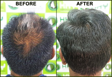 HHY Hair Transplant Clinic in Andheri west - Mumbai, Bhubaneswar & Guwahati.