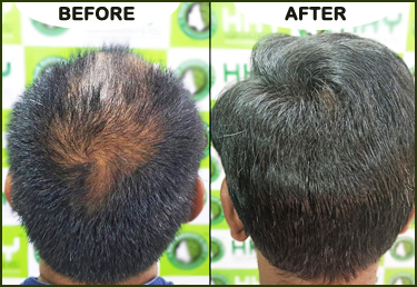 How to have the Best of Hair Transplant in Bhubaneswar by Radiance Clinics   Issuu