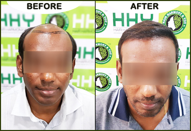 Hair Transplant Surgery clinic in Guwahati at affordable Cost